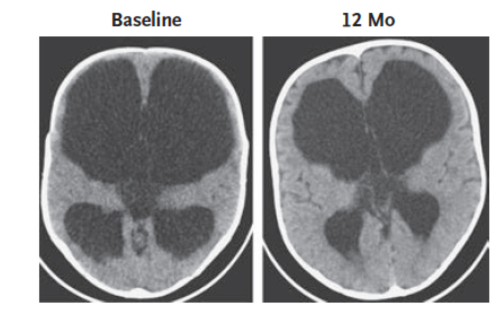CT scans of infant brains.  Scan on the left shows infant’s brain before endoscopic surgery (ETV-CPC).  Scan on the right shows 12-month postoperative scan of the same infant’s brain.